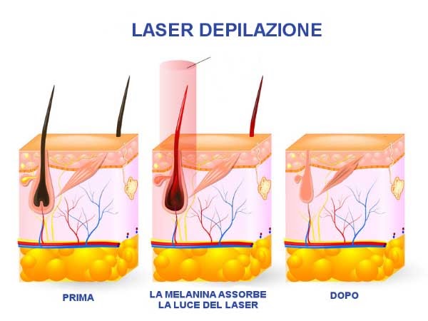 Epilazione laser progressiva permanente - Studio Medico UAU